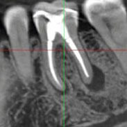 Dental Implants X-Ray